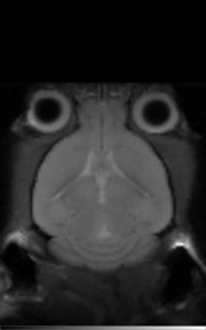 MRI T2影像